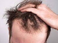 شش درمان طبیعی برای ریزش مو