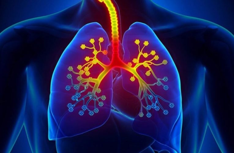 درمان آنتی‌بادی ۹۲ درصد از موارد شدید آسم را کنترل می‌کند