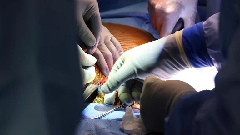 اولین بیمار دریافت‌کننده کلیه اصلاح‌شده خوک درگذشت