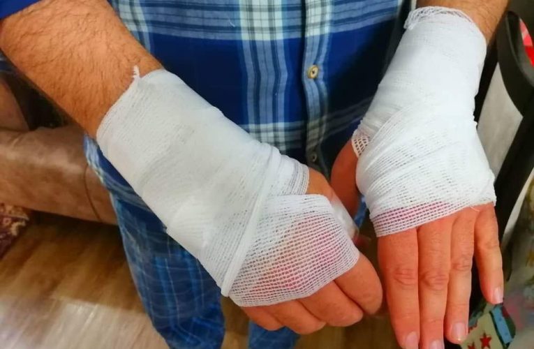 بیمه سلامت هزینه سوختگی را چطور پوشش می‌دهد – خبرگزاری مهر | اخبار ایران و جهان_تاشکن