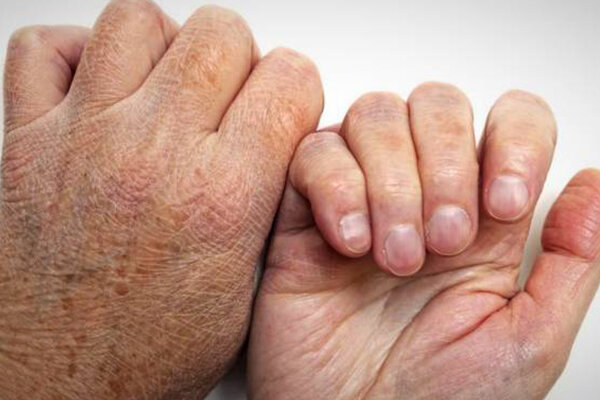 جذام قابل درمان است/ آمار ابتلا در جهان و ایران - خبرگزاری مهر | اخبار ایران و جهان