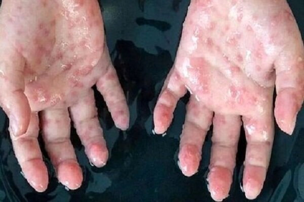 شناسایی آبله میمونی در همسایگی ایران/ بهداشت فردی را جدی بگیرید - خبرگزاری مهر | اخبار ایران و جهان