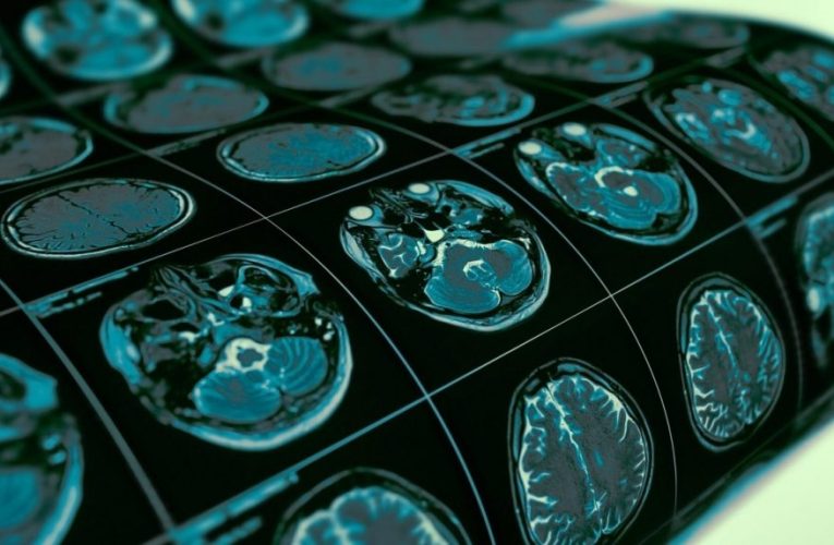 ژن‌درمانی با میدان مغناطیسی به جنگ پارکینسون می‌رود_تاشکن