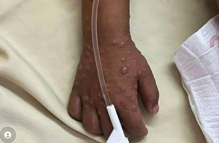 افزایش ۵۰۰ درصدی موارد آبله میمون در آفریقا – خبرگزاری مهر | اخبار ایران و جهان_تاشکن