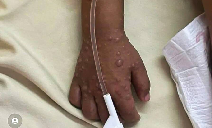 افزایش ۵۰۰ درصدی موارد آبله میمون در آفریقا - خبرگزاری مهر | اخبار ایران و جهان