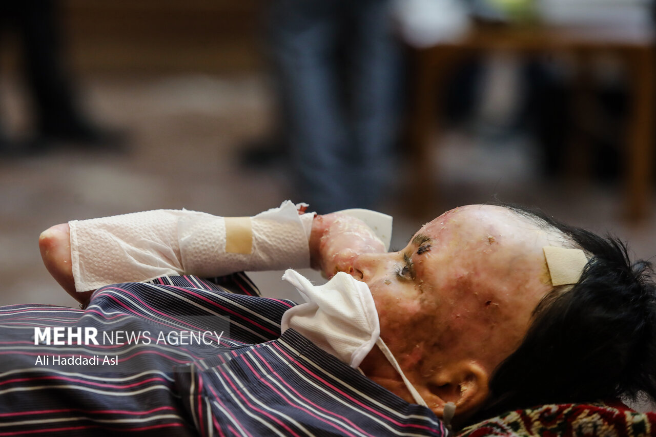 پانسمان بیماران پروانه‌ای همچنان کمبود دارد - خبرگزاری مهر | اخبار ایران و جهان