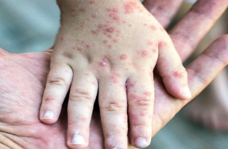 تست آنتی‌بادی ضد سرخک هیچ مبنای علمی ندارد – خبرگزاری مهر | اخبار ایران و جهان_تاشکن